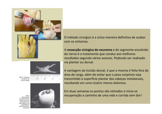 O método cirúrgico é a única maneira definitiva de acabar
com os sintomas.
A ressecção cirúrgica do neuroma e do segmento envolvido
do nervo é o tratamento que conduz aos melhores
resultados segundo vários autores. Podendo ser realizado
via plantar ou dorsal.
A vantagem da incisão dorsal, é que a mesma é feita fora da
área de carga, além de evitar que o peso corpóreo seja
transmitido à superfície plantar das cabeças metatarsais,
resultando em uma cicatriz menos dolorosa.
Em duas semanas os pontos são retirados e inicia-se
recuperação a caminho de uma vida e corrida sem dor!
 