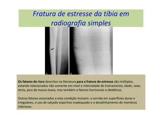 Fratura de estresse da tíbia em
radiografia simples
Os fatores de risco descritos na literatura para a fratura de estresse são múltiplos,
estando relacionados não somente em nível e intensidade do treinamento, idade, sexo,
etnia, pico de massa óssea, mas também a fatores hormonais e dietéticos.
Outros fatores associados a esta condição incluem: a corrida em superfícies duras e
irregulares, o uso de calçado esportivo inadequado e o desalinhamento de membros
inferiores.
 