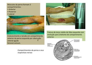 Músculos da perna formam 3
compartimentos:
• Anterior
• Posterior
• Lateral
Endurecimento e tensão em compartimento
anterior da perna esquerda por obstrução
arterial aguda
femoral comum.
E
D
Fratura de terço médio de tíbia esquerda com
evolução para síndrome de compartimento
anterior.
Compartimentos da perna e seus
respectivos nervos
 