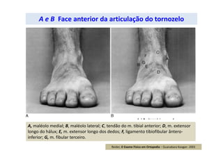 A e B Face anterior da articulação do tornozelo
A, maléolo medial; B, maléolo lateral; C, tendão do m. tibial anterior; D, m. extensor
longo do hálux; E, m. extensor longo dos dedos; F, ligamento tibiofibular ântero-
inferior; G, m. fibular terceiro.
Reider, O Exame Físico em Ortopedia – Guanabara Koogan -2001
 