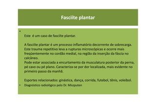 Fasciíte plantar
•
Este é um caso de fasciíte plantar.
A fasciíte plantar é um processo inflamatório decorrente de sobrecarga.
Este trauma repetitivo leva a rupturas microscópicas e ocorre mais
freqüentemente no cordão medial, na região da inserção da fáscia no
calcâneo.
Pode estar associada a encurtamento da musculatura posterior da perna,
pé cavo ou pé plano. Caracteriza-se por dor localizada, mais evidente no
primeiro passo da manhã.
Esportes relacionados: ginástica, dança, corrida, futebol, tênis, voleibol.
• Diagnóstico radiológico pelo Dr. Miszputen
 