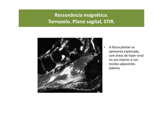 Ressonância magnética.
Tornozelo. Plano sagital, STIR.
• A fáscia plantar se
apresenta espessada,
com áreas de hiper-sinal
no seu interior e nos
tecidos adjacentes
(edema
 
