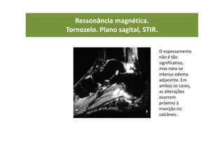 Ressonância magnética.
Tornozelo. Plano sagital, STIR.
O espessamento
não é tão
significativo,
mas nota-se
intenso edema
adjacente. Em
ambos os casos,
as alterações
ocorrem
próximo à
inserção no
calcâneo.
 