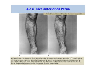 A e B Face anterior da Perna
A, borda subcutânea da tíbia; B, músculos do compartimento anterior; C, local típico
de fratura por estresse da crista anterior; D, local de peritendinite tibial anterior; E,
local de possível compressão do nervo fibular superficial.
Reider, O Exame Físico em Ortopedia – Guanabara Koogan -2001
 