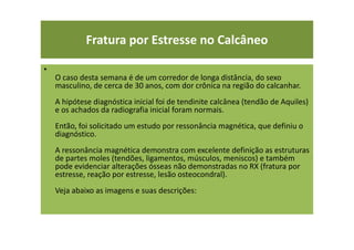 Fratura por Estresse no Calcâneo
•
O caso desta semana é de um corredor de longa distância, do sexo
masculino, de cerca de 30 anos, com dor crônica na região do calcanhar.
A hipótese diagnóstica inicial foi de tendinite calcânea (tendão de Aquiles)
e os achados da radiografia inicial foram normais.
Então, foi solicitado um estudo por ressonância magnética, que definiu o
diagnóstico.
A ressonância magnética demonstra com excelente definição as estruturas
de partes moles (tendões, ligamentos, músculos, meniscos) e também
pode evidenciar alterações ósseas não demonstradas no RX (fratura por
estresse, reação por estresse, lesão osteocondral).
Veja abaixo as imagens e suas descrições:
 