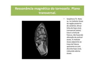 Ressonância magnética do tornozelo. Plano
transversal.
• Seqüência T1. Nota-
se, na medular óssea
da região posterior
do calcâneo, tênue
linha de hipo-sinal,
transversal (setas).
Esta é a linha de
fratura, não havendo
alteração da cortical
óssea. A medular
óssea adjacente ao
traço de fratura
apresenta-se com
discreto hipo-sinal,
indicando edema
ósseo.
 