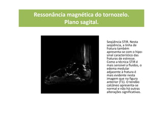 Ressonância magnética do tornozelo.
Plano sagital.
Seqüência STIR. Nesta
seqüência, a linha de
fratura também
apresenta-se com o hipo-
sinal característico das
fraturas de estresse.
Como a técnica STIR é
mais sensível a fluidos, o
edema medular
adjacente à fratura é
mais evidente nesta
imagem que na figura
anterior (T1). O tendão
calcâneo apresenta-se
normal e não há outras
alterações significativas.
 