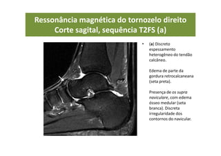 Ressonância magnética do tornozelo direito
Corte sagital, sequência T2FS (a)
• (a) Discreto
espessamento
heterogêneo do tendão
calcâneo.
Edema de parte da
gordura retrocalcaneana
(seta preta).
Presença de os supra
naviculare, com edema
ósseo medular (seta
branca). Discreta
irregularidade dos
contornos do navicular.
 