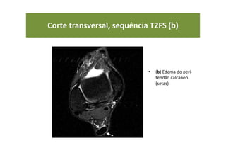Corte transversal, sequência T2FS (b)
• (b) Edema do peri-
tendão calcâneo
(setas).
 