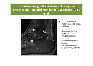 Ressonância magnética do tornozelo esquerdo
Cortes sagitais (medial para lateral), sequência T2 FS
(c, d)
• (c) Espessamento
heterogêneo do tendão
calcâneo.
Edema de parte da
gordura
retrocalcaneana.
Discreto edema nas
bursas
retrocalcaneanas
superficial e profunda.
 