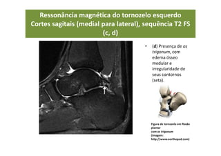 • (d) Presença de os
trigonum, com
edema ósseo
medular e
irregularidade de
seus contornos
(seta).
Figura de tornozelo em flexão
plantar
com os trigonum
(imagem:
http://www.eorthopod.com)
Ressonância magnética do tornozelo esquerdo
Cortes sagitais (medial para lateral), sequência T2 FS
(c, d)
 