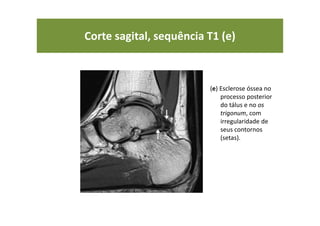 Corte sagital, sequência T1 (e)
(e) Esclerose óssea no
processo posterior
do tálus e no os
trigonum, com
irregularidade de
seus contornos
(setas).
 