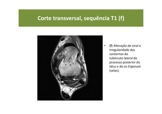 Corte transversal, sequência T1 (f)
• (f) Alteração de sinal e
irregularidade dos
contornos do
tubérculo lateral do
processo posterior do
tálus e do os trigonum
(setas).
 