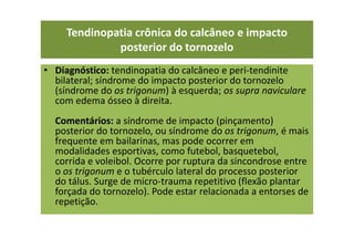 • Diagnóstico: tendinopatia do calcâneo e peri-tendinite
bilateral; síndrome do impacto posterior do tornozelo
(síndrome do os trigonum) à esquerda; os supra naviculare
com edema ósseo à direita.
Comentários: a síndrome de impacto (pinçamento)
posterior do tornozelo, ou síndrome do os trigonum, é mais
frequente em bailarinas, mas pode ocorrer em
modalidades esportivas, como futebol, basquetebol,
corrida e voleibol. Ocorre por ruptura da sincondrose entre
o os trigonum e o tubérculo lateral do processo posterior
do tálus. Surge de micro-trauma repetitivo (flexão plantar
forçada do tornozelo). Pode estar relacionada a entorses de
repetição.
Tendinopatia crônica do calcâneo e impacto
posterior do tornozelo
 