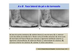 A e B Face lateral do pé e do tornozelo
A, base do quinto metatarso; B, maléolo lateral; C, seio do tarso; D, m. extensor
curto dos dedos; E, tendão do m. fibular curto; F, tendão calcanear; G, nervo sural;
H, local típico de fratura fibular por estresse; I, ligamento talofibular anterior; J,
ligamento calcaneofibular; K, tubérculo fibular; L, tuberosidade do calcâneo; M,
processo anterior do calcâneo; N, cubóide; O, bolsa subcutânea.
Reider, O Exame Físico em Ortopedia – Guanabara Koogan -2001
 