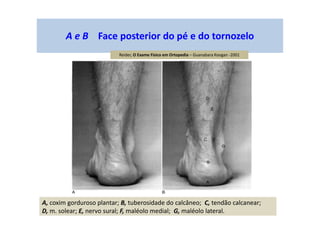 A e B Face posterior do pé e do tornozelo
A, coxim gorduroso plantar; B, tuberosidade do calcâneo; C, tendão calcanear;
D, m. solear; E, nervo sural; F, maléolo medial; G, maléolo lateral.
Reider, O Exame Físico em Ortopedia – Guanabara Koogan -2001
 