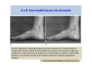 A e B Face medial do pé e do tornozelo
A, arco longitudinal medial; B, cabeça do primeiro metatarso; C, tuberosidade do
calcâneo; D, maléolo medial; E, tuberosidade do navicular; F, veia safena magna; G,
tendão do m. tibial posterior; H, tendão do m. flexor longo dos dedos; I, artéria tibial
posterior; J, local típico de fratura do maléolo medial por estresse; K, ligamento
deltóide.
Reider, O Exame Físico em Ortopedia – Guanabara Koogan -2001
 