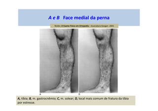 A e B Face medial da perna
A, tíbia; B, m. gastrocnêmio; C, m. solear; D, local mais comum de fratura da tíbia
por estresse.
Reider, O Exame Físico em Ortopedia – Guanabara Koogan -2001
 