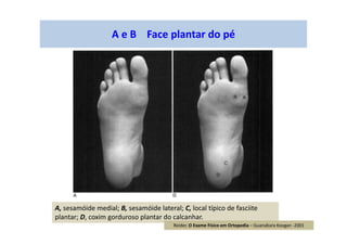 A e B Face plantar do pé
A, sesamóide medial; B, sesamóide lateral; C, local típico de fasciite
plantar; D, coxim gorduroso plantar do calcanhar.
Reider, O Exame Físico em Ortopedia – Guanabara Koogan -2001
 