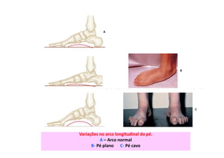 Variações no arco longitudinal do pé.
A – Arco normal
B- Pé plano C- Pé cavo
 