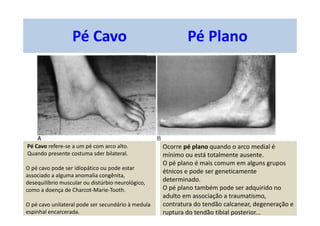 Pé Cavo Pé Plano
Pé Cavo refere-se a um pé com arco alto.
Quando presente costuma sder bilateral.
O pé cavo pode ser idiopático ou pode estar
associado a alguma anomalia congênita,
desequilíbrio muscular ou distúrbio neurológico,
como a doença de Charcot-Marie-Tooth.
O pé cavo unilateral pode ser secundário à medula
espinhal encarcerada.
Ocorre pé plano quando o arco medial é
mínimo ou está totalmente ausente.
O pé plano é mais comum em alguns grupos
étnicos e pode ser geneticamente
determinado.
O pé plano também pode ser adquirido no
adulto em associação a traumatismo,
contratura do tendão calcanear, degeneração e
ruptura do tendão tibial posterior...
 