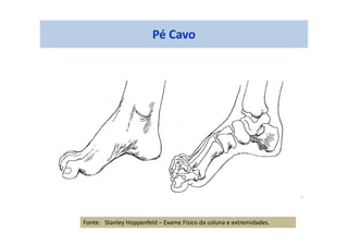 Pé Cavo
Fonte: Stanley Hoppenfeld – Exame Físico da coluna e extremidades.
 