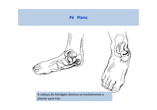 Pé Plano
A cabeça do Astrágalo desloca-se medialmente e
plantar para trás.
 