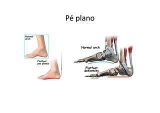 Pé plano
 