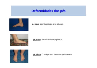 Deformidades dos pés
pé cavo- acentuação do arco plantar.
pé plano- ausência do arco plantar.
pé aduto. O antepé está desviado para dentro.
 