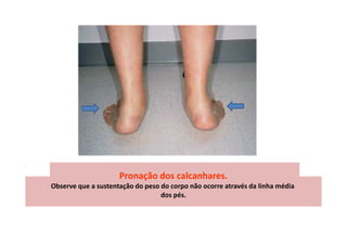 Pronação dos calcanhares.
Observe que a sustentação do peso do corpo não ocorre através da linha média
dos pés.
 