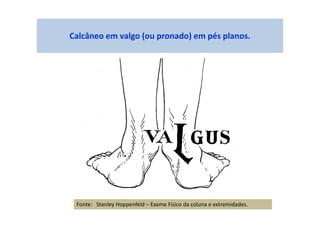 Calcâneo em valgo (ou pronado) em pés planos.
Fonte: Stanley Hoppenfeld – Exame Físico da coluna e extremidades.
 
