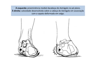 À esquerda: proeminência medial dacabeça do Astrágalo no pé plano.
À direita: calosidade desenvolvida sobre a cabeça do Astrágalo em associação
com o sapato deformado em valgo.
 