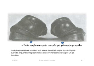 figura
10/12/2015 Dr. José Heitor M. Fernandes 80
Uma proeminência excessiva no lado medial do calçado sugere um pé valgo ou
evertido, enquanto uma proeminência excessiva na face lateral sugere um pé
invertido.
 