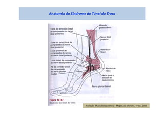 Anatomia do Síndrome do Túnel do Traso
Avaliação Musculoesquelética – Magee,DJ; Manole , 4ª ed., 2005
 
