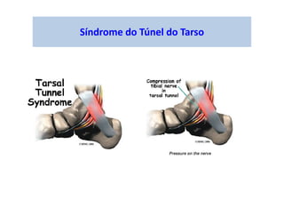 Síndrome do Túnel do Tarso
 