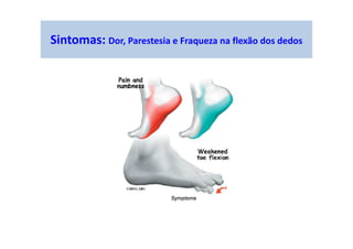 Sintomas: Dor, Parestesia e Fraqueza na flexão dos dedos
 