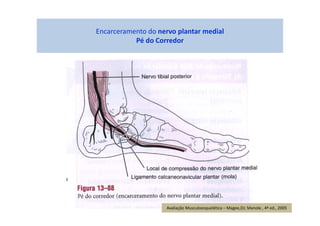 Encarceramento do nervo plantar medial
Pé do Corredor
Avaliação Musculoesquelética – Magee,DJ; Manole , 4ª ed., 2005
 