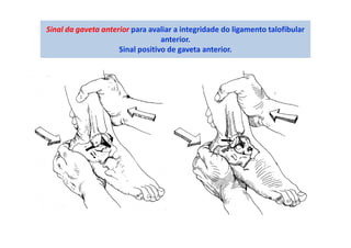 Teste da Gaveta Anterior (tornozelo)
A seta indica a direção da força aplicada ao calcanhar.
Fonte: Magee, D J; Orthopedic...