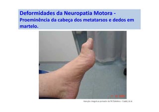 Deformidade da Neuropatia Motora -
Proeminência dos metatarsos com hiperceratose (calo) e
hematoma sub-dérmico.
 