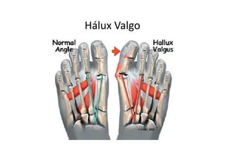Hálux Valgo – causas: sapato de bico fino
 