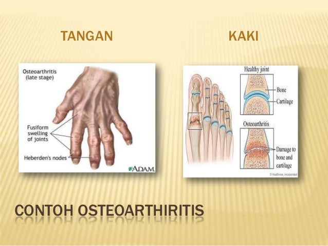Qgj3023 (penyakit osteoarthritis)