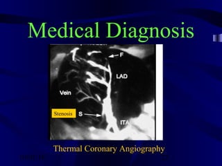 10/02/16 23
Medical Diagnosis
Thermal Coronary Angiography
Stenosis
 