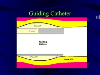 10/02/16 60
Guiding Catheter
 
