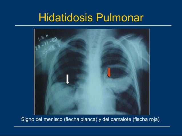 Signo Del Camalote Hidatidosis Signo Del Camalote Hidatidosis