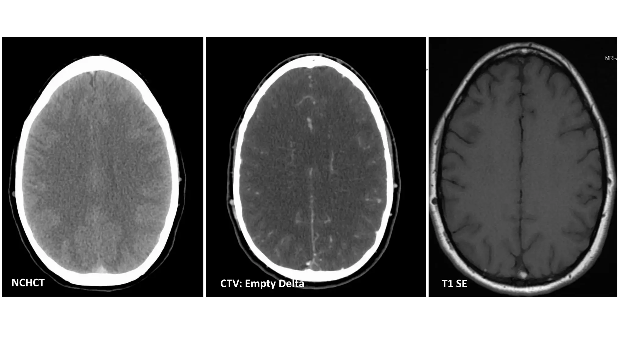 NeuroImaging Nibble Subtle Sinus Venous Thrombosis | PDF