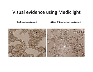 VisualevidenceusingMediclight
Visual evidence using Mediclight
  Beforetreatment
  Before treatment   After25minutetreatment
                     After 25 minute treatment
 