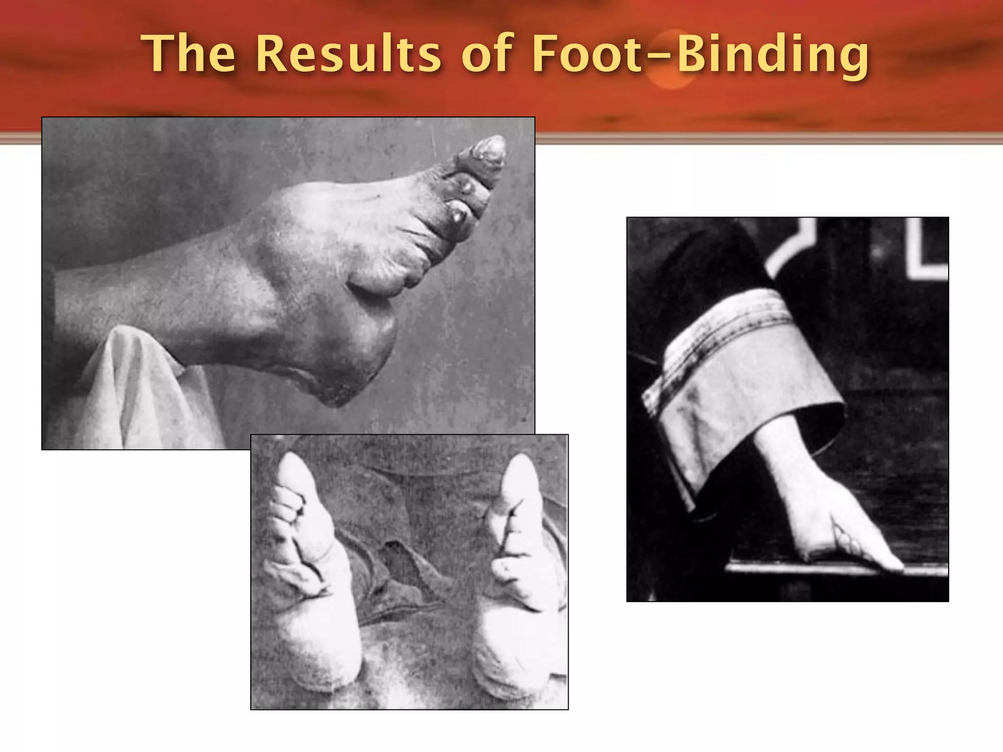 The Results of Foot-Binding
 