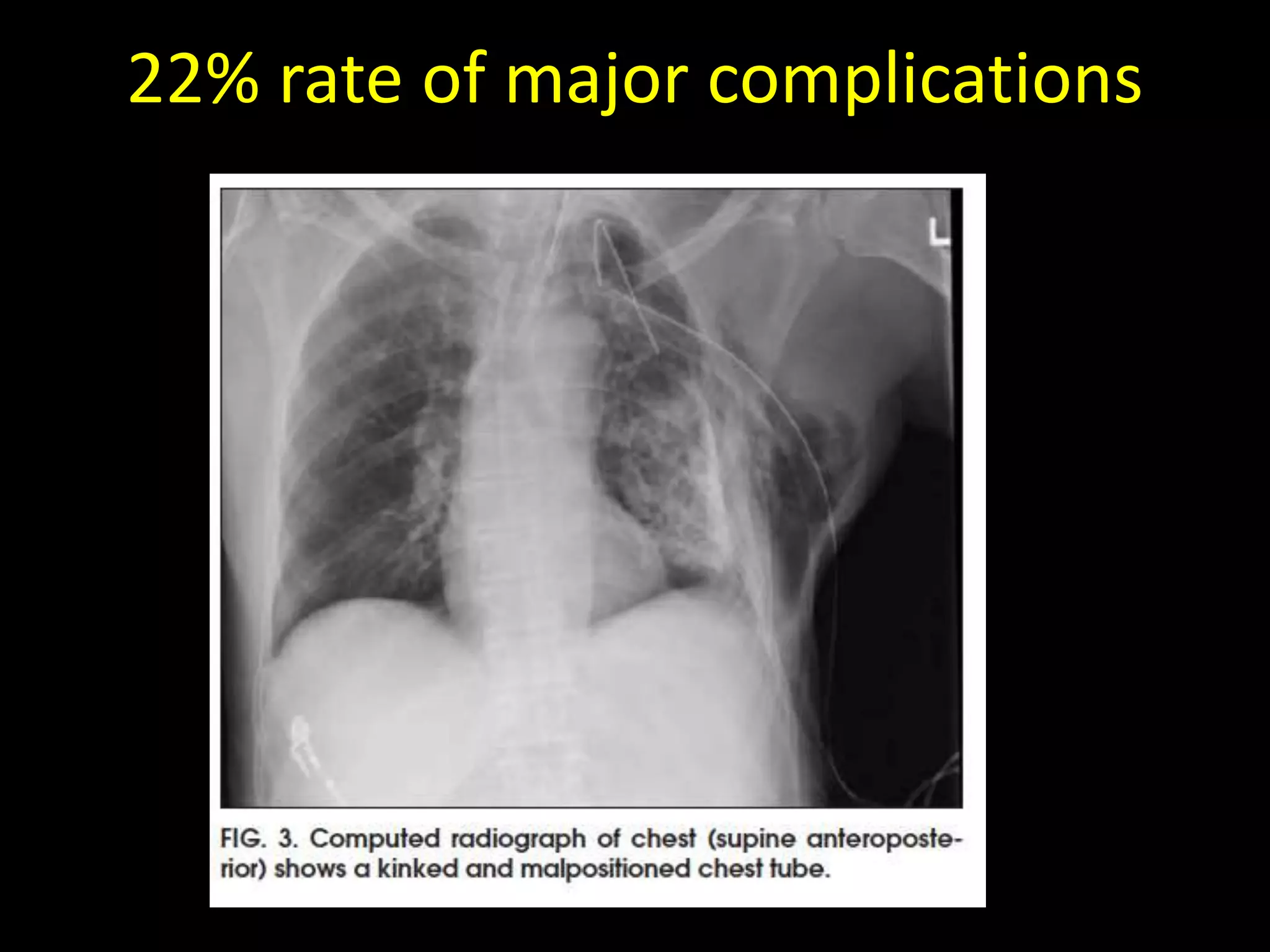 22% rate of major complications
 