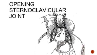 OPENING
STERNOCLAVICULAR
JOINT
 