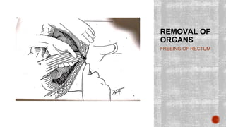 REMOVAL OF
ORGANS
FREEING OF RECTUM
 